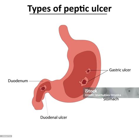 Types Of Peptic Ulcer Vector Illustration Stock Illustration - Download ...