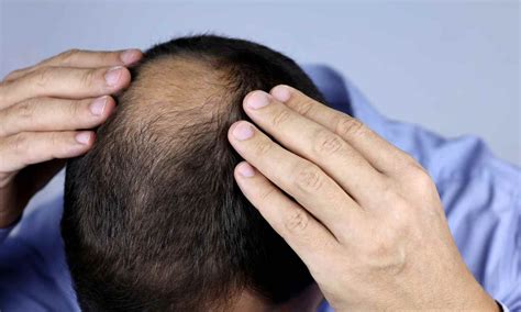 Topical Clascoterone 5% Shows Significant Hair Regrowth Without ...