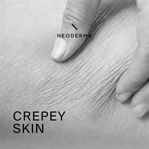 Crepey Skin Dehydration | Crepe Paper Skin Treatment | NEODERMA