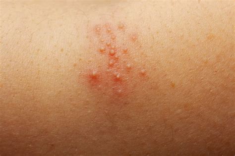 Q&A: What causes heat rash? | Expert Opinion