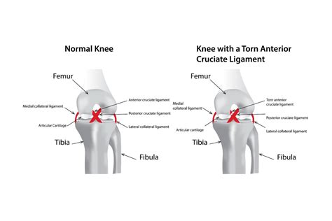 Knee Acl Mechanism
