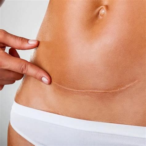 Benefits of Enhanced Recovery After Surgery (ERAS) Protocols for ...