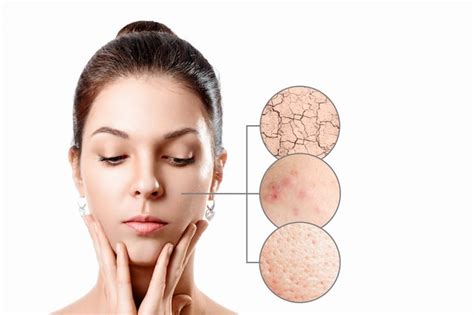 Young woman with acne, dry skin, black dots skin in zoom circle . young ...