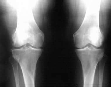 Primary Osteoarthritis Imaging: Overview, Radiography, Computed Tomography