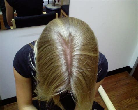 Dry Scalp Is The Reason For Hair Loss - Rewaj | Women Lifestyle