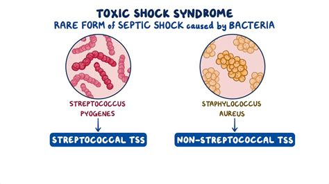 What Causes Toxic Syndrome at Sofia Flick blog