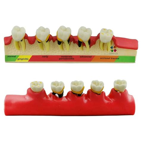 Buy iDENTical Dental Model-Stages of Periodontitis M4010 Online at Low ...