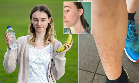 Teenager suffers 40 different allergies - including WATER