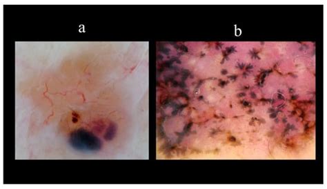 Basal Cell Carcinoma: From Pathophysiology to Novel Therapeutic Approaches