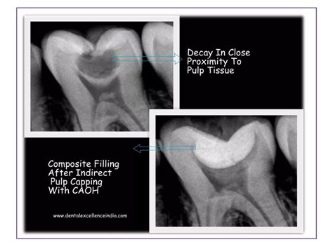 Image result for Difference Between Direct and Indirect Pulp Capping