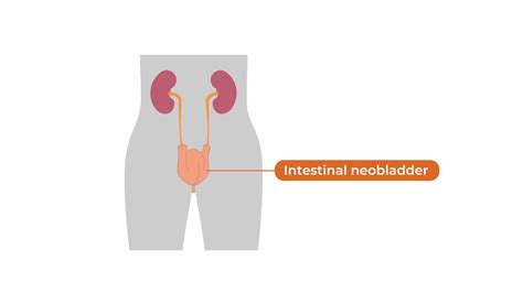 Urinary Diversion: What Is It? What Are My Options? | BCAN