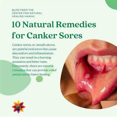 Top 10 Home Remedies Canker Sores at Eva Brown blog