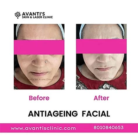 Image result for Small Dimples