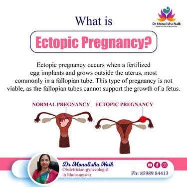 Ectopic Pregnancy Best Womens Health Doctor Dr Monalisa Naik ...