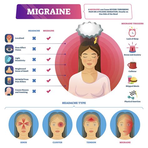 Migraine - AppLocum : AppLocum