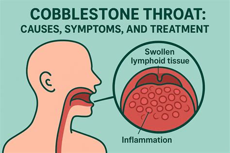 Cobblestone Throat Pictures