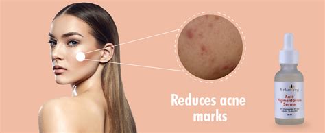 Urban Yog Face Care Combo Kit- Anti-Pigmentation Serum (30 ml) and Acne ...