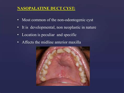 Nasopalatine Duct Cyst