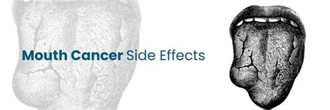 Side Effects Management of Mouth Cancer Treatment