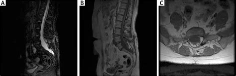 Tethered Cord Syndrome In Kbg Syndrome – JCDAT