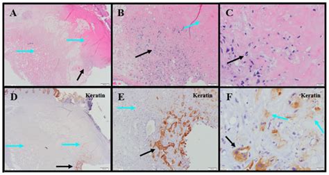 Local Injection of Submicron Particle Docetaxel is Associated with ...
