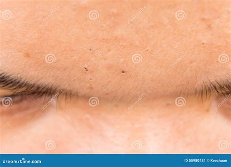 Ugly Pimples, Acne, Zit and Blackheads on the Forehead of a Teenager Stock Image - Image of hair ...