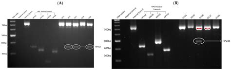 Detection of High-Risk Human Papillomavirus in Bladder Cancer: An ...