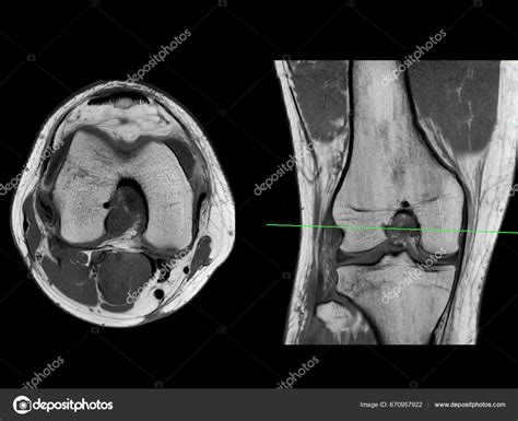 Mri Knee Axial Mri Knee Joint Magnetic Resonance Imaging