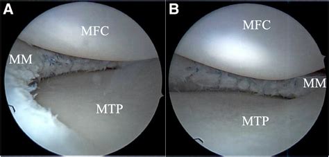Horizontal Cleavage Tear Meniscal Repair Using All-Inside Circumferential Compression Sutures ...