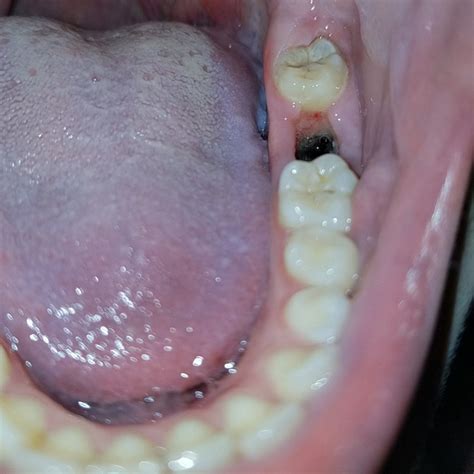 List 92+ Pictures Day-by Day Tooth Extraction Healing Pictures Superb