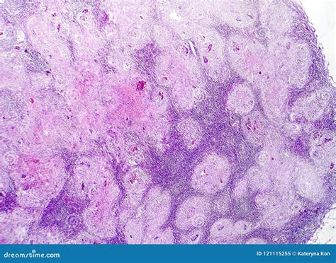Caseous Necrosis Lymph Node