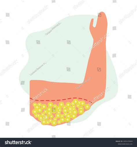 Arm Lift Surgery Arm Lipedema Liposuction Stock Vector (Royalty Free) 2251172919 | Shutterstock