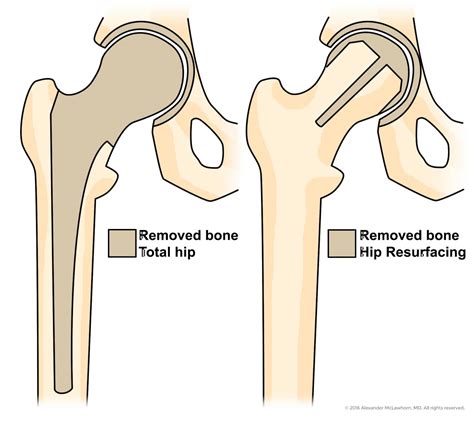 Hip Resurfacing Surgery NYC - Surface Replacement Stamford CT