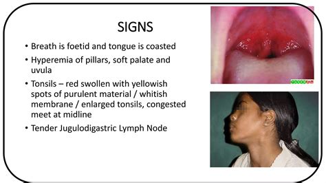 Acute and Chronic Tonsillitis | PPTX