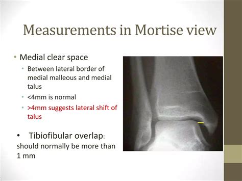 Ankle joint radiography | PPTX