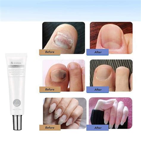 Maximum Strength Nail Fungus Treatment Cream - Antifungal Toenail & Fingernail Remover | Buy Now ...