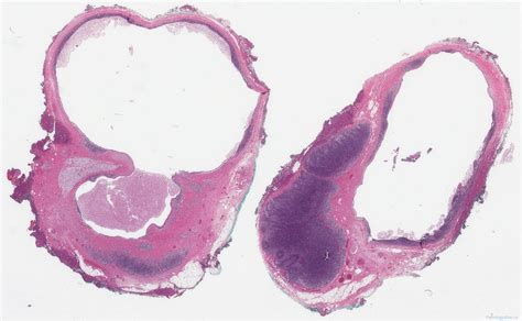 Branchial cleft cyst | Ottawa Atlas of Pathology