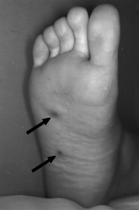 Imaging Characteristics of Blue Rubber Bleb Nevus Syndrome | AJR
