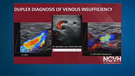 President Trump's diagnosis sheds light on common vein condition ...