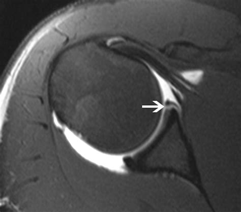 Shoulder MR Arthrography: Which Patient Group Benefits Most? | AJR
