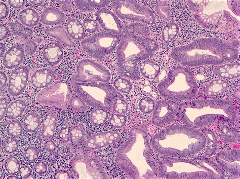 Is Tubular Adenoma With High Grade Dysplasia Cancer