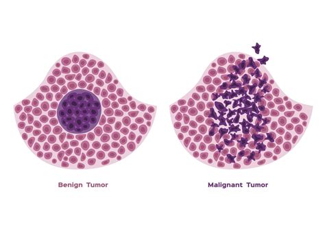 Benign vs. Malignant Tumors: What's the Difference?