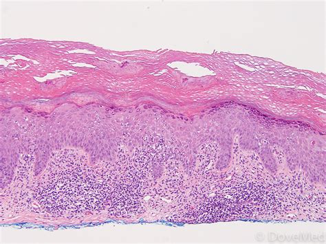 Hypertrophic Lichen Planus