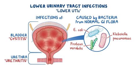 Video: Lower urinary tract infection: Clinical sciences | Osmosis
