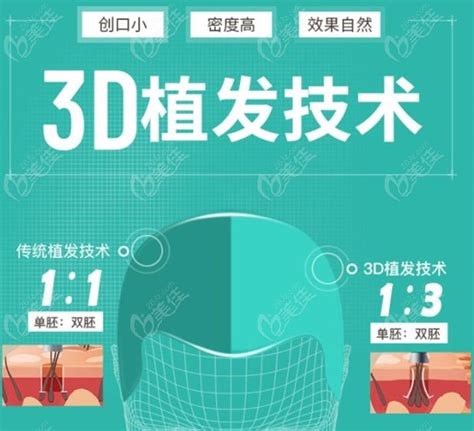 杭州新生tddp和3D植发价格是多少钱一个毛囊?这两个技术有什么区别 - 美佳社区