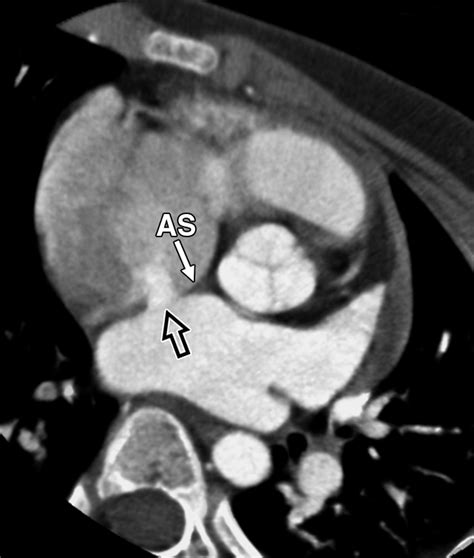 Amplatzer Septal Occluder Closure of Atrial Septal Defect: Evaluation of Transthoracic ...