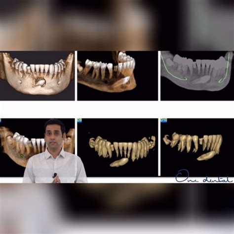How to study impacted teeth on a CBCT-One Dental is the Biggest online ...