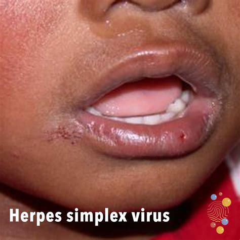 Neonatal herpes - Don't Forget the Bubbles