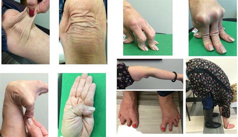 A Guide To Living With Ehlers-Danlos Syndrome (Hypermobility Type) at ...