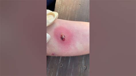 Image result for Worst Exploding Pimple